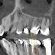 2016 03 15 14 57 56 831 2016 03 16 Cbct Fig8 Thumb