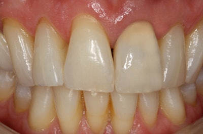 Fig. 7: The tooth's gingival third was stained with a darker A3 stain.