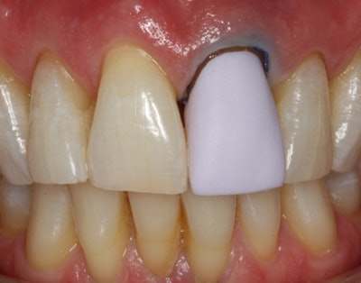 Fig. 6: The restoration requires a crystallization process to stain and glaze.