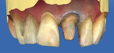 Figs. 4 and 5: The software proposes a shape for #9 based on #8.