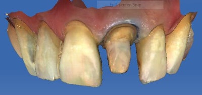 Fig. 3: Image of the adjacent teeth.