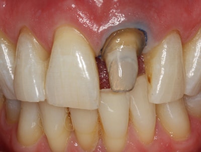Fig. 2: Modified incisal edge of #8.
