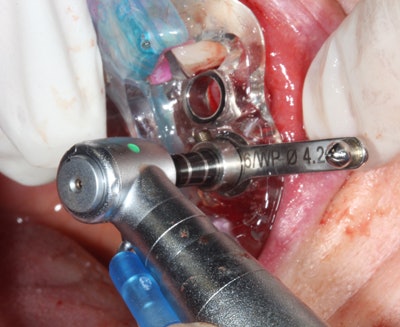 Figure 14: Final implant osteotomy.