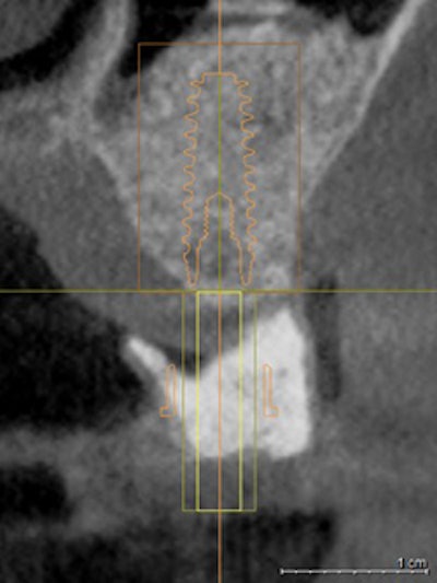 Figure 6: A virtual implant.