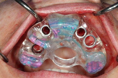 Figure 7: SICAT surgical guide in place.