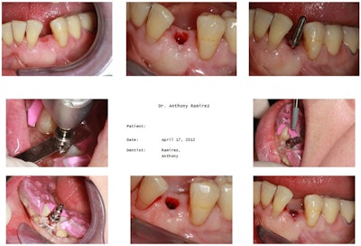 2016 04 20 11 19 06 323 2016 04 28 Implantology3 800