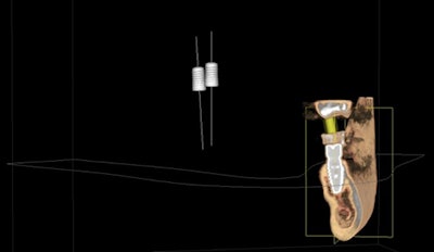 Figure 5: Actual guided implant 3D view post-op.