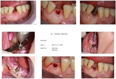 2016 04 20 11 19 07 76 2016 04 28 Implantology3 400