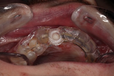 Figure 4: Surgical guide fabricated in office using chairside milling for guided surgery.