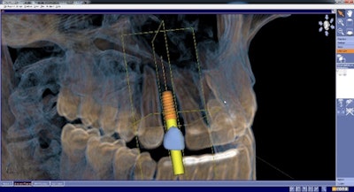 Figure 3: 3D treatment planning of implant and restoration.