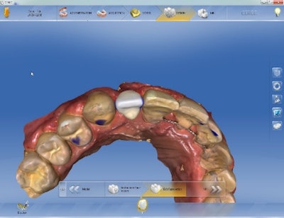Figure 2: Virtual tooth wax-up.