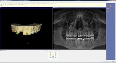 Figure 1: Integration of data between CAD/CAM and CBCT. All images courtesy of Dr. Neal Patel.