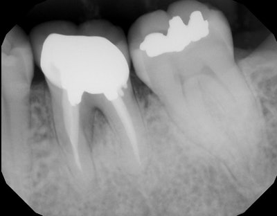 Figure 1: Preoperative digital radiograph of a nonrestorable mandibular molar. All images courtesy of Dr. Timothy Kosinski.