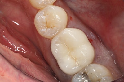 Figures 2 and 3: The crowned tooth is to be extracted, and the site prepared for future dental implant placement.