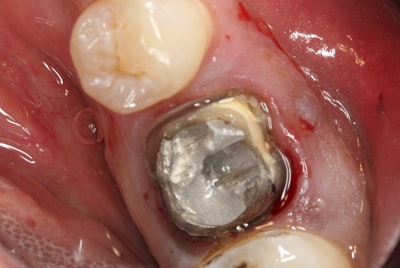 Figure 9: Using a surgical bur, the lower molar is sectioned into two roots, where now the tooth can be extracted as two individual roots.