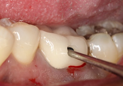 Figure 7 (above): The WAMkey #1, the smallest size instrument in terms of head size, is inserted into the opening. The head of the instrument lays flat when inserted into the crown. Once the instrument has been inserted the instrument is simply turned a quarter turn with your fingertips, allowing the instrument head to stand upward and to gently break or release the cement layer, as well as the crown to be removed in an efficient manner. Figure 8 (below): This image shows that the crown is completely preserved, and it makes for a great temporary or it can even be reused on a permanent basis.