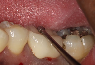 Figure 4: The WAMkey crown remover is used to remove the crown before the tooth can be sectioned.