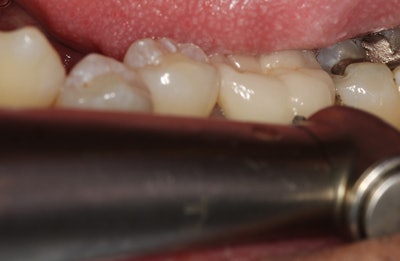 Figure 5: A small opening or “window” is made on the buccal side of the tooth, where the goal of such window is to identify where the cement layer is between the crown and the tooth.