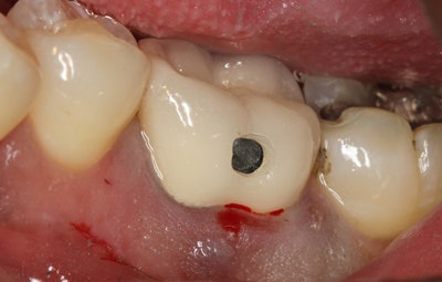 Figure 6: Once the position is located by feel or using loupes, the channel should extend into the center of the cement layer as it is best to leverage from the center of the preparation or on the long axis of the tooth.