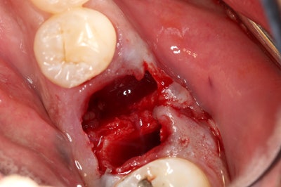 Figure 9: The extraction site. The socket site is aggressively curetted, removing any granulation tissue resulting from the socket.