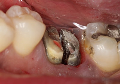 Figure 1: Using a surgical bur, the lower molar divergent roots are sectioned into two roots, where now the tooth can be extracted as two individual roots using the Physics Forceps. All images courtesy of Dr. Timothy Kosinski.
