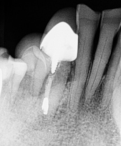 Apicoectomy completed at oral surgeon's office.