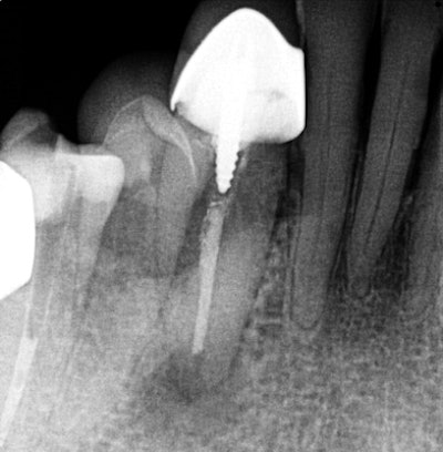 Emergency Schick 33 periapical radiograph.
