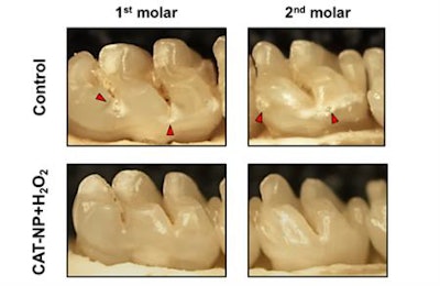 Treatment with the nanoparticle-hydrogen peroxide treatment delayed the onset and severity of tooth decay. Image courtesy of the University of Pennsylvania.