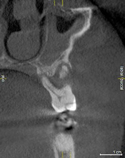 Bone pathology on #3.