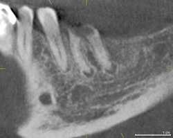 Hopeless tooth #19. All images courtesy of Dr. Anthony Ramirez.