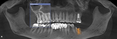 Extract, bone graft, and implant on #14 and #19.