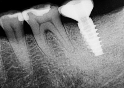 Implant restored.