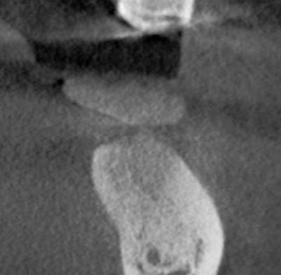 Regenerated bone preimplant, #18.