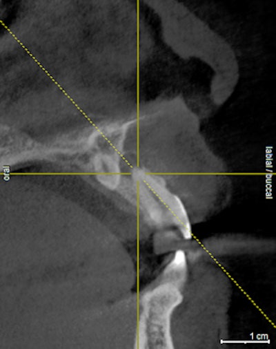 Mesiodens and periapical pathology, #9.