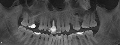 Above: Initial panoramic image. Below: Pathology on #8 and #13.