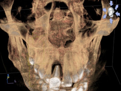 Above: Exfoliating max central incisor. Below: Pathology on #12 and #13.