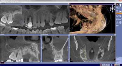 Above: Incidentalomas on #3 and #13. Below: Sinus pathology in right sinus and periodontal disease.