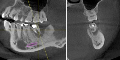 Left: Perio-endo lesion on #18. Right: Cross-sectional view of #18.