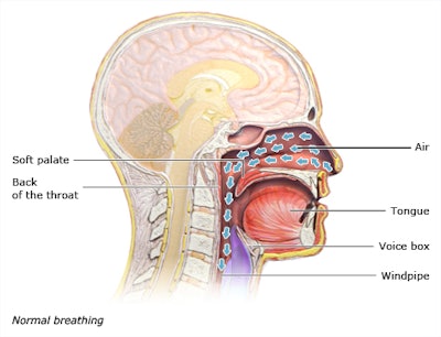 Above: Drawing of unobstructed airflow in a patient. Below: Drawing of an obstructed airflow in a patient. Images courtesy of Dr. Joseph Krainin.