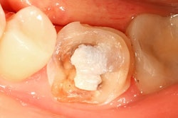 2016 12 07 12 53 05 25 Restoration Tooth 400