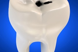 2016 08 03 14 14 54 148 Tooth Caries 400