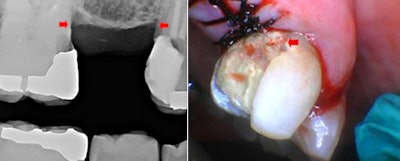 Figure 7 (left): Radiograph shows the level of the alveolar bone before closure with the level of the alveolus indicated with red arrows. Figure 8 (right): The progression of tissue level is shown apically.