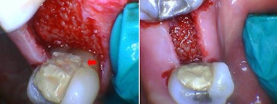 Figure 5 (left): The red arrow shows the bone level relative to a reference point near the cementoenamel junction after bone ablation before suturing. Figure 6 (right): The flap is shown before approximation and suturing.