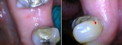 Figures 9 and 10: At five-month follow-up, the ridge and gingiva around teeth #3 and #5 were healthy with normal periodontal probing depths.