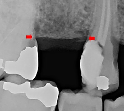 Figure 1: The patient's bone level is shown by the red arrows in this preoperative radiograph.