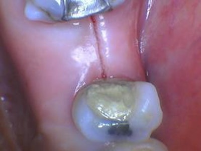 Figure 4: An initial scalpel-like incision was made along the crest of the edentulous ridge.
