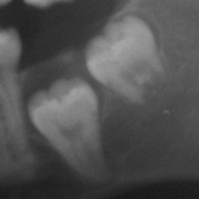 2013 12 18 17 31 50 654 Third Molar 200