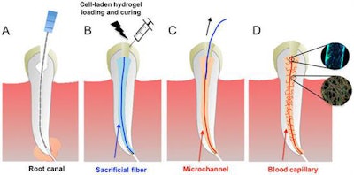 Schematic diagram illustrating the basic steps of the proposed strategy to engineer prevascularized full-length dental pulp-like tissue constructs. (A) The root canal is prepared following common endodontic procedure using endodontic files. (B) A premade sacrificial fiber is positioned in the root canal. A cell-laden hydrogel is loaded into the canal and photopolymerized. (C) After the hydrogel photopolymerization, the sacrificial fiber is removed, creating a hollow microchannel that traverses the entire length of the canal, from the apex through the pulp chamber. (D) Endothelial cells are seeded in the fabricated microchannel to engineer the core vascular capillary in the dental pulp, thus resulting in a prevascularized full-length dental pulp-like tissue construct. All images courtesy of 'A Novel Strategy to Engineer Pre-Vascularized Full-Length Dental Pulp-like Tissue Constructs' (Scientific Reports, June 12, 2017).