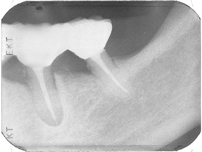 A radiograph taken 4.5 years later shows long-term success with periapical healing, bone fill, and the bridge in place.