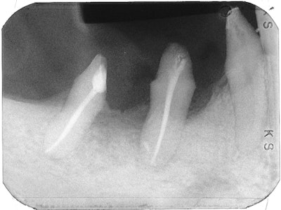 Radiograph five months later shows resorption of extrusion and healing of periapical lesion.